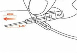 如何使用留置针