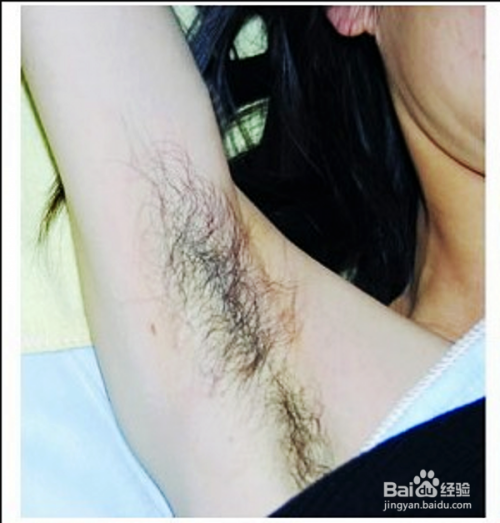 女性得了多毛症怎么办 百度经验