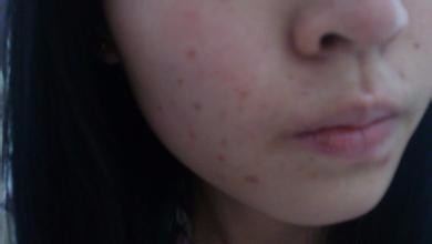 如何保养自己漂亮的脸蛋,防止涨痘痘