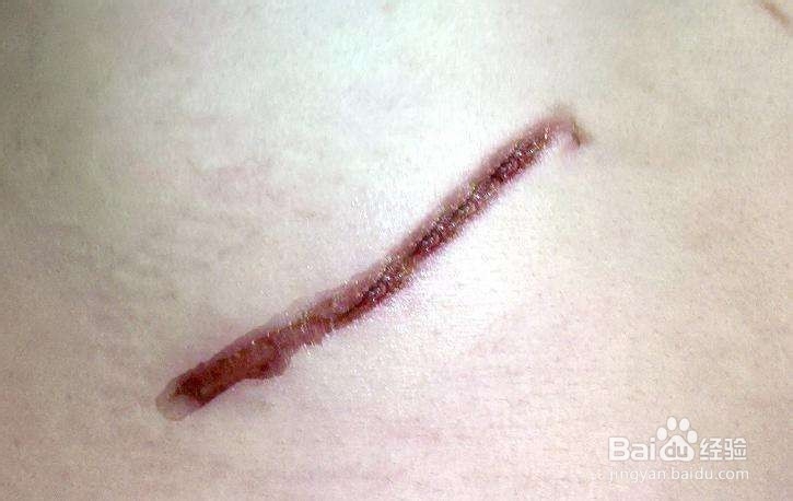 怎么祛陈年旧疤