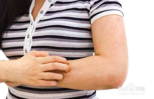 如何分辨湿疹和癣