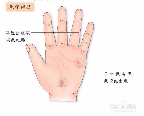 子宫肌瘤怎么办？子宫肌瘤手操疗法缓解病状