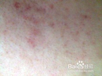 痘坑怎么去除