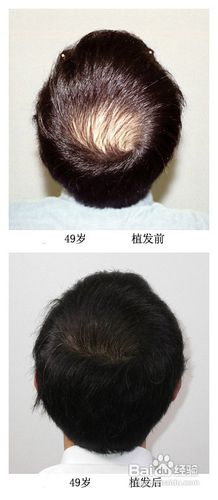 脱发治疗的价格多少脱发治疗要多少钱
