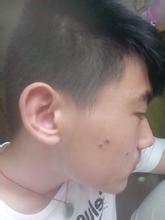 点痣有哪些危害