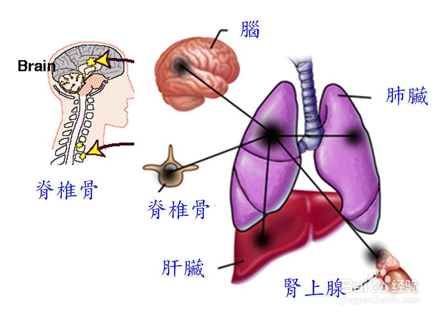 非小细胞癌的治疗方法