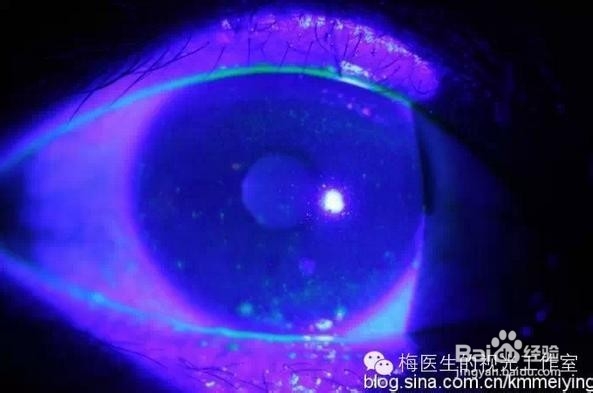 经常流眼泪的原因与治疗