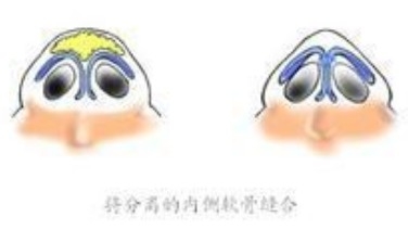 深圳蒜头鼻手术恢复时间是多长