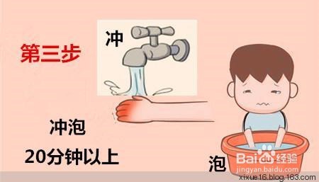 意外烫伤紧急自救法则