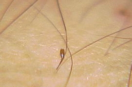 小偏方治疗男性阴囊瘙痒