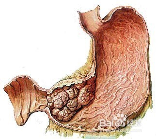 【警惕】这4种腹泻是癌症的报警信号！