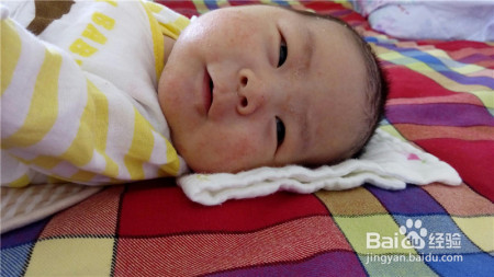 宝宝出现湿疹治疗时,应注意哪些?