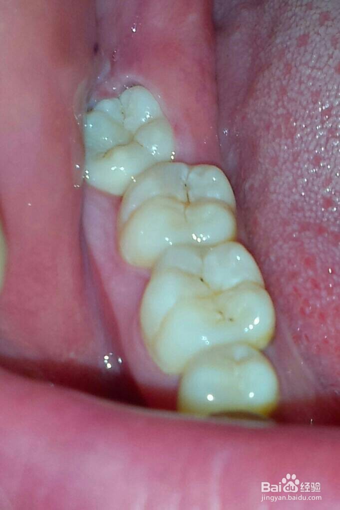 拔掉智齿\阻生牙的流程步骤