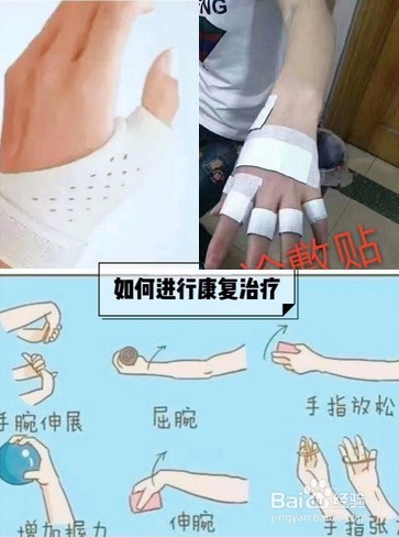 什么是妈妈手？科普知识如何自测妈妈手？
