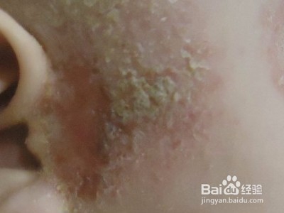 宝宝湿疹怎么办