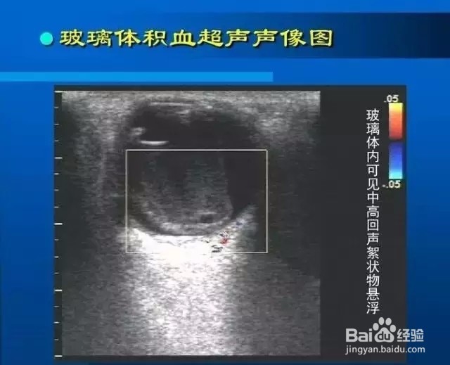 几种常见眼病B超图谱及诊断