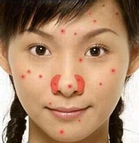 脸部痘痘辨别自己的身体信号！