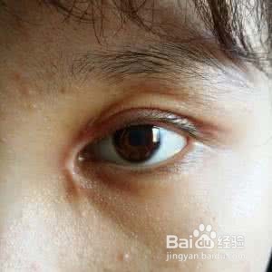 开眼角后常常无刺激下流眼泪怎么办？