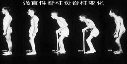 强直性脊椎炎的症状与治疗办法