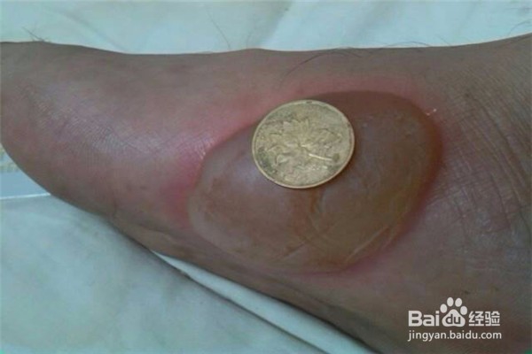 手被烟花烧疼了怎么最快好