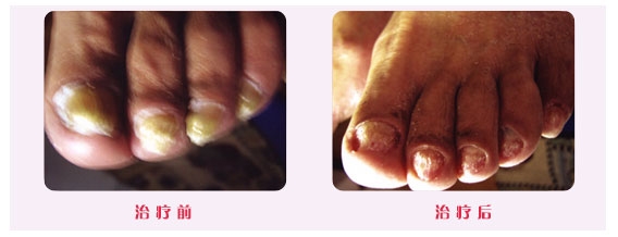 最常见的四种灰指甲治疗方法免费分享