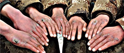 冻疮的药物治疗方法