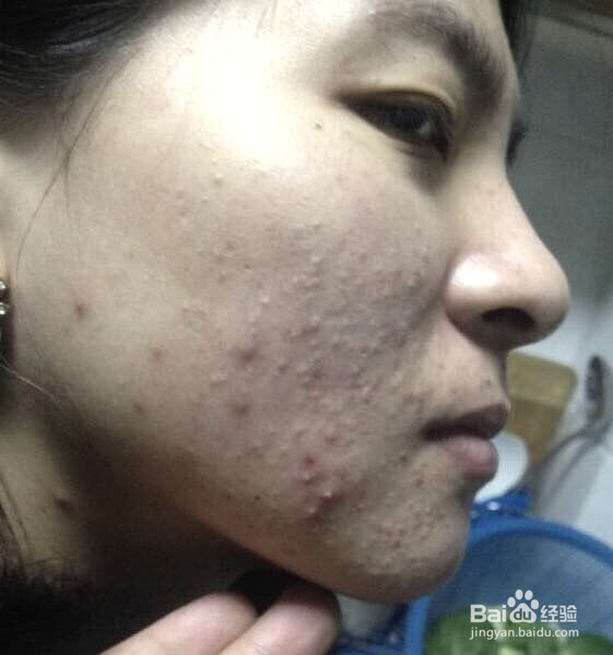 排毒祛痘怎么做?