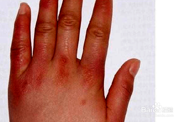 冬天来了,怎样防治冻疮?