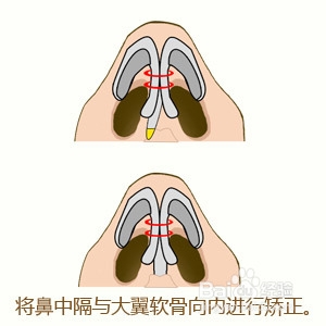 鼻小柱整形解决方案