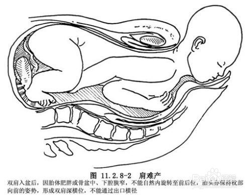 肩难产的七步处理方法