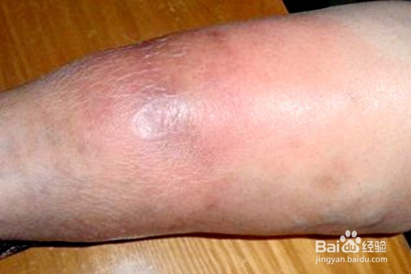 怎样从脚辨病？