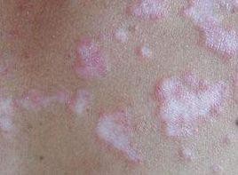 红斑狼疮是什么病，你了解吗?