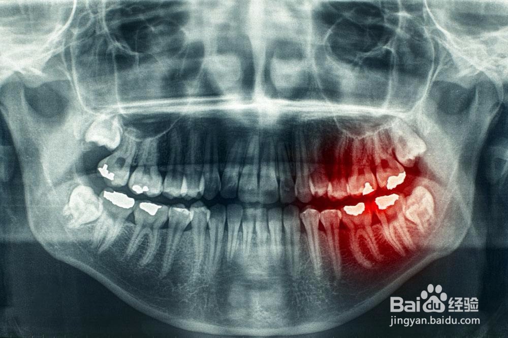 发现自己长智齿了怎么办？