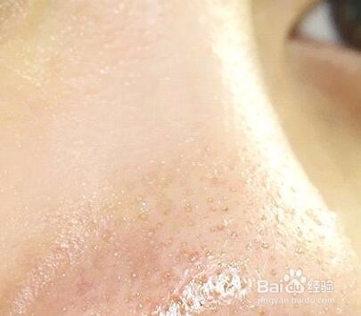 如何改善油性皮肤毛孔粗大的状况