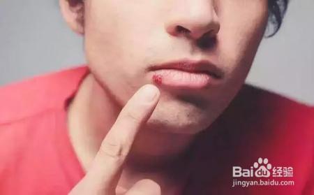 烂嘴角就一定是上火吗?为啥总爱秋冬季高发?