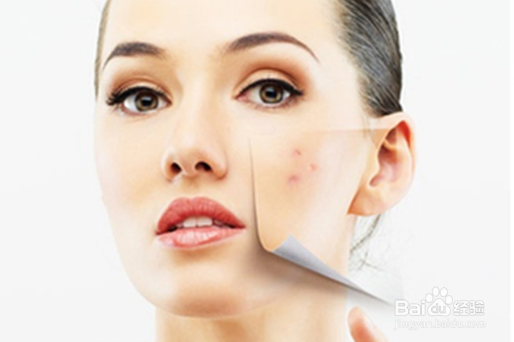 脸上长痘痘的调理小妙招
