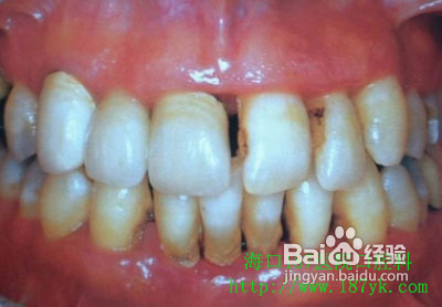 牙齿松动了怎么办