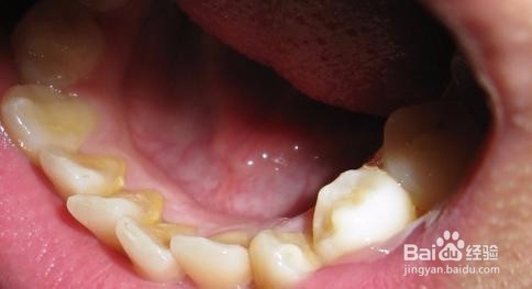 怎么知道有牙石