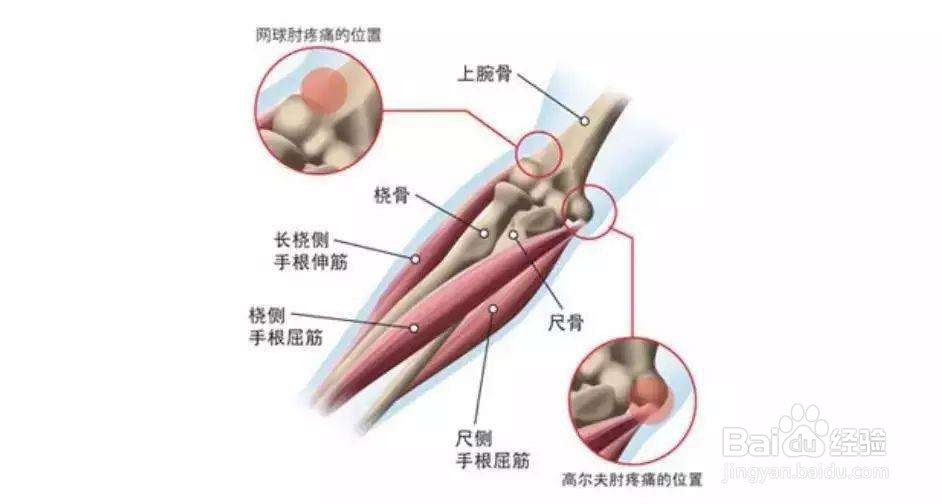 网球肘疼痛怎么治疗