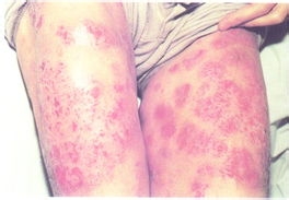 小偏方治疗男性阴囊瘙痒