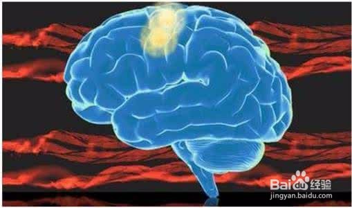 突发脑溢血的急救方法