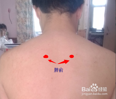 艾灸治疗过敏性鼻炎