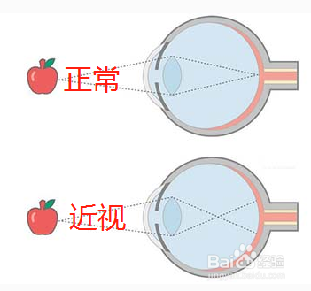 近视有什么影响吗