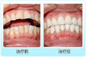 贵金属烤瓷牙优势是什么