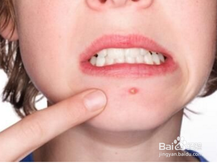 内分泌失调引发长痘痘怎么办？