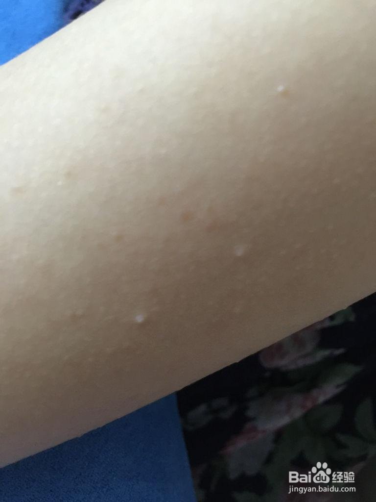 胳膊肘疙瘩掉皮怎么办