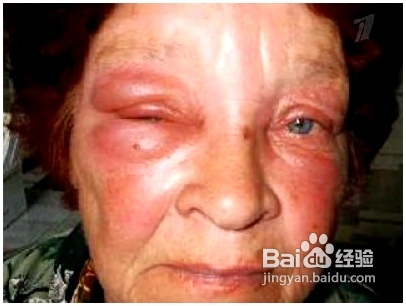 被马蜂蛰了怎么消肿