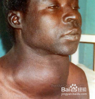 碘盐能吃出甲状腺病?还能好好吃盐吗?