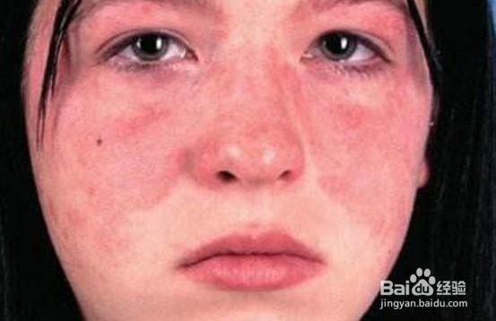 哪些情况需要到风湿免疫科就诊