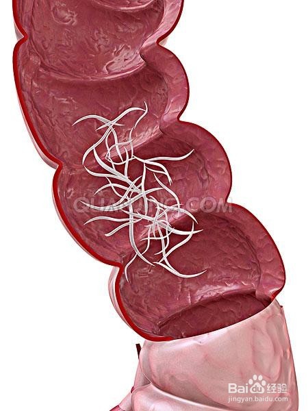 如何治疗宝宝湿疹